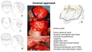 Coronal approach
Access areas
Entire calvarial vault
•Anterior and lateral skull base
•Frontal sinus/Ethmoid
•Zygoma
•Zygomatic arch
•Orbit (lateral/cranial/medial)
•Nasal dorsum
•Temporomandibular joint (TMJ)
•Condyle and subcondylar region
 