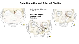 Open Reduction and Internal Fixation
• Disimpaction done by –
Asch’s forceps
• Requires 3-point
exposure and
fixation.
 