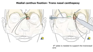 Medial canthus fixation- Trans nasal canthopexy
4th plate is needed to support the transnasal
wire
 