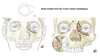 Barb ended wire for Trans nasal canthopexy
 