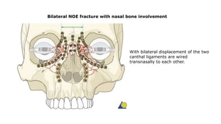 Bilateral NOE fracture with nasal bone involvement
With bilateral displacement of the two
canthal ligaments are wired
transnasally to each other.
 