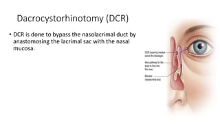 Dacrocystorhinotomy (DCR)
• DCR is done to bypass the nasolacrimal duct by
anastomosing the lacrimal sac with the nasal
mucosa.
 