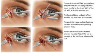 The sac is dissected free from its bony
attachments and the bony ostium is
made medial to the lower part of the
sac with a 10-mm trephine bur.
The lacrimal bone and part of the
anterior lacrimal crest are removed.
The posterior nasal and sac flaps are
sutured, as are the corresponding
anterior flaps.
Hollwich has modified – that the
anterior mucosal flap of the sac is
sutured to the overlying subcuticular
skin.
 