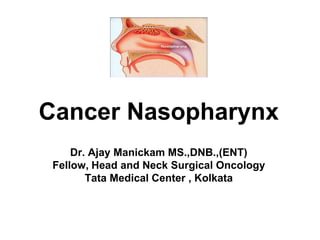 Cancer Nasopharynx
Dr. Ajay Manickam MS.,DNB.,(ENT)
Fellow, Head and Neck Surgical Oncology
Tata Medical Center , Kolkata
 