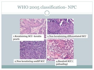 Npc Pathology Classification Nasopharyngeal cancer | PPTX