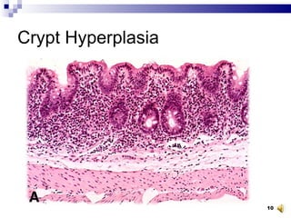 Crypt Hyperplasia 