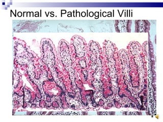 Normal vs. Pathological Villi 