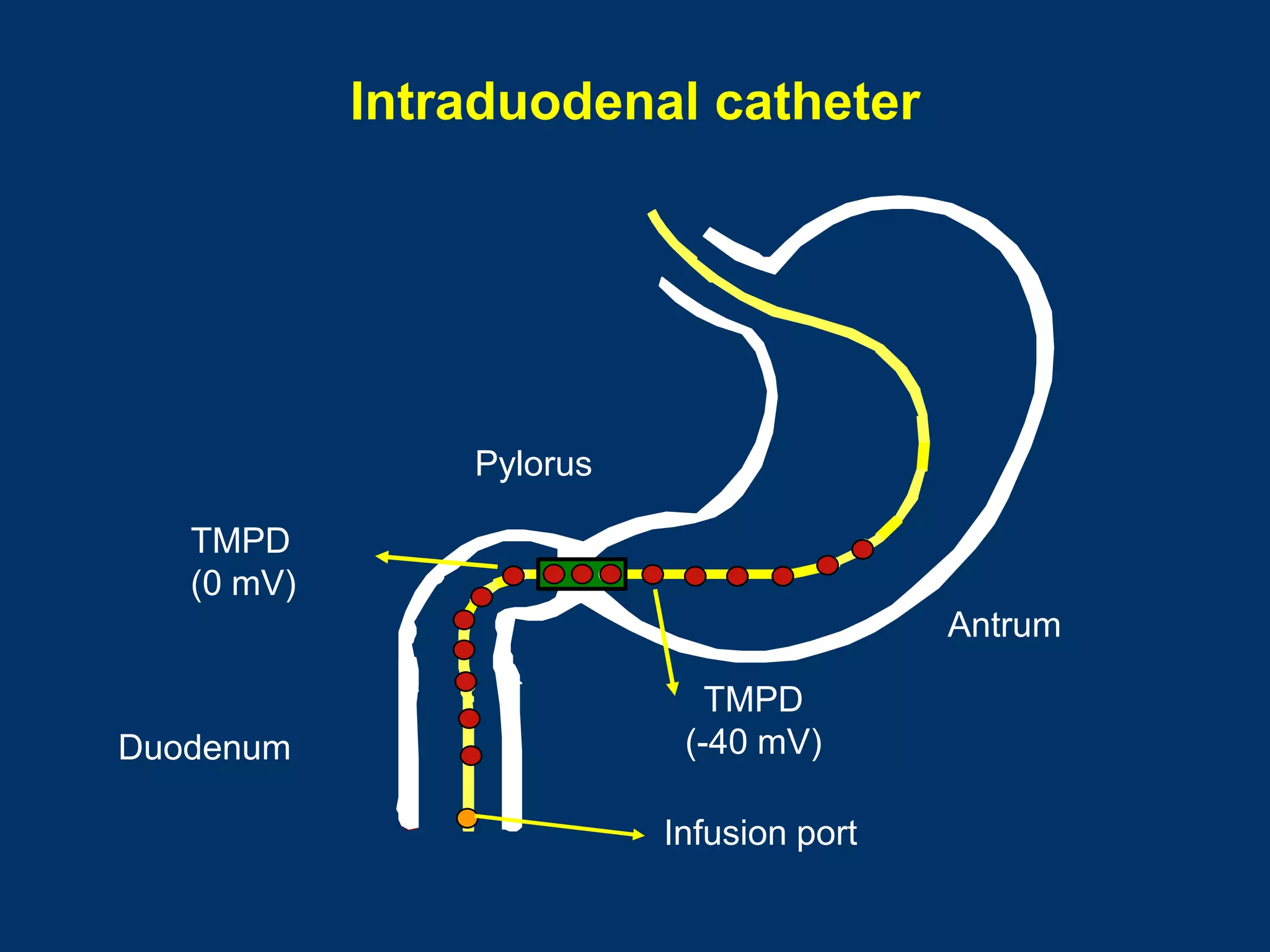 Intraduodenal catheter




                Pylorus

   TMPD
   (0 mV)
                                          Antrum

                             TMPD
Duodenum                   (-40 mV)

                          Infusion port
 