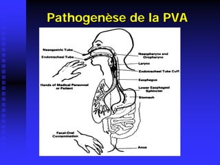 Pathogenèse de la PVA  