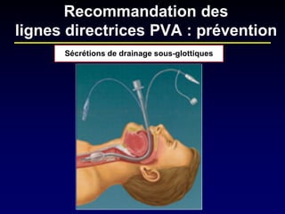 Sécrétions de drainage sous-glottiques 
Recommandation des lignes directrices PVA : prévention  