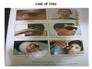 CARE OF EYES
 