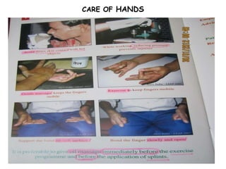 CARE OF HANDS
 
