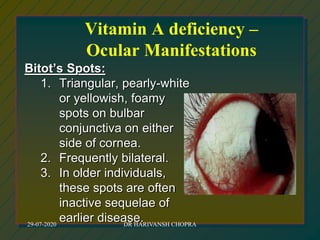 Vitamin A deficiency –
Ocular Manifestations
Bitot’s Spots:
1. Triangular, pearly-white
or yellowish, foamy
spots on bulbar
conjunctiva on either
side of cornea.
2. Frequently bilateral.
3. In older individuals,
these spots are often
inactive sequelae of
earlier disease.29-07-2020 DR HARIVANSH CHOPRA
 
