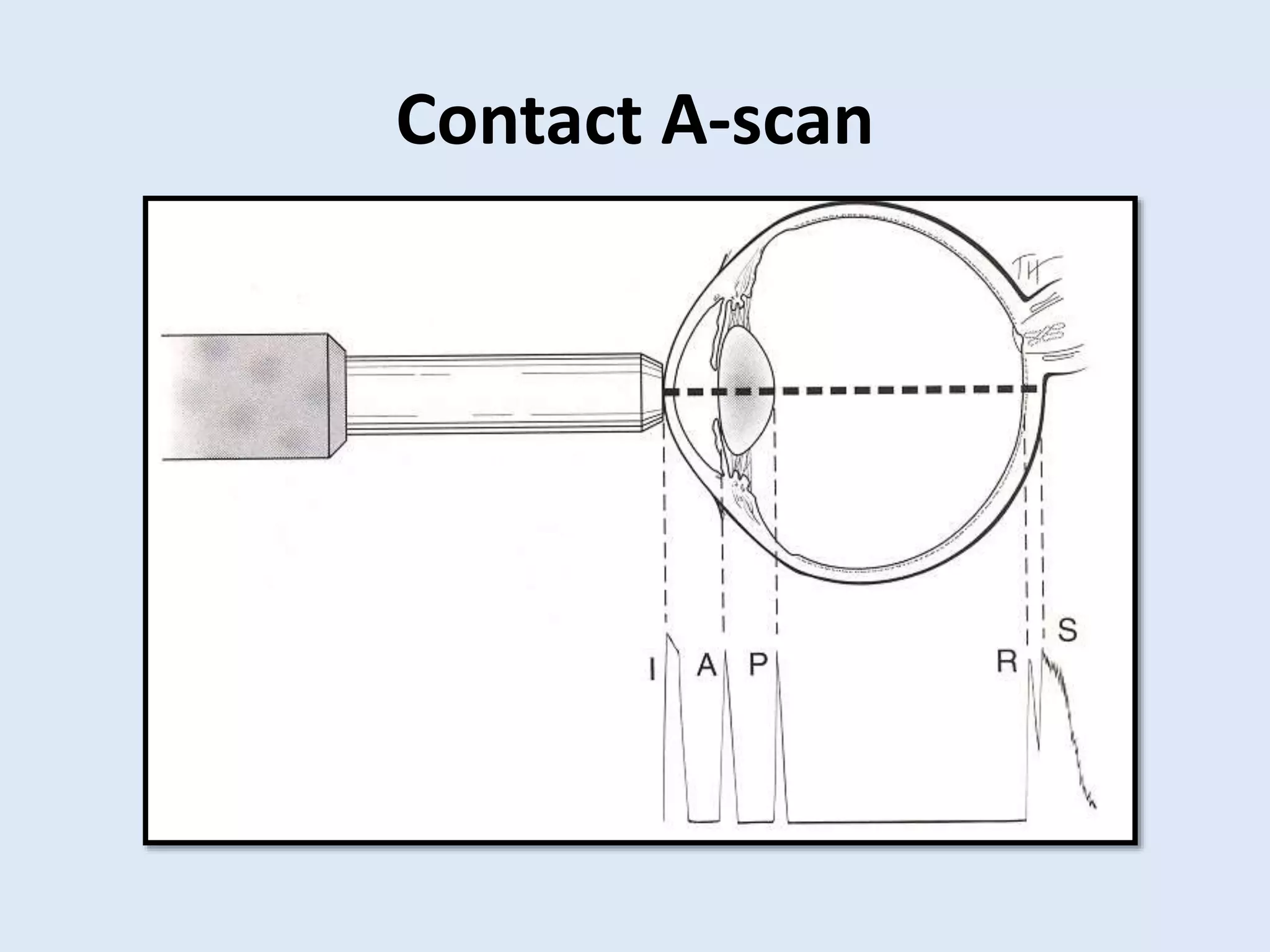 Contact A-scan
 