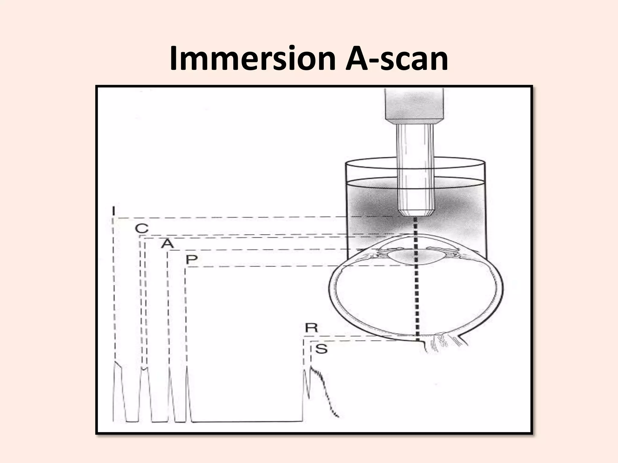 Immersion A-scan
 