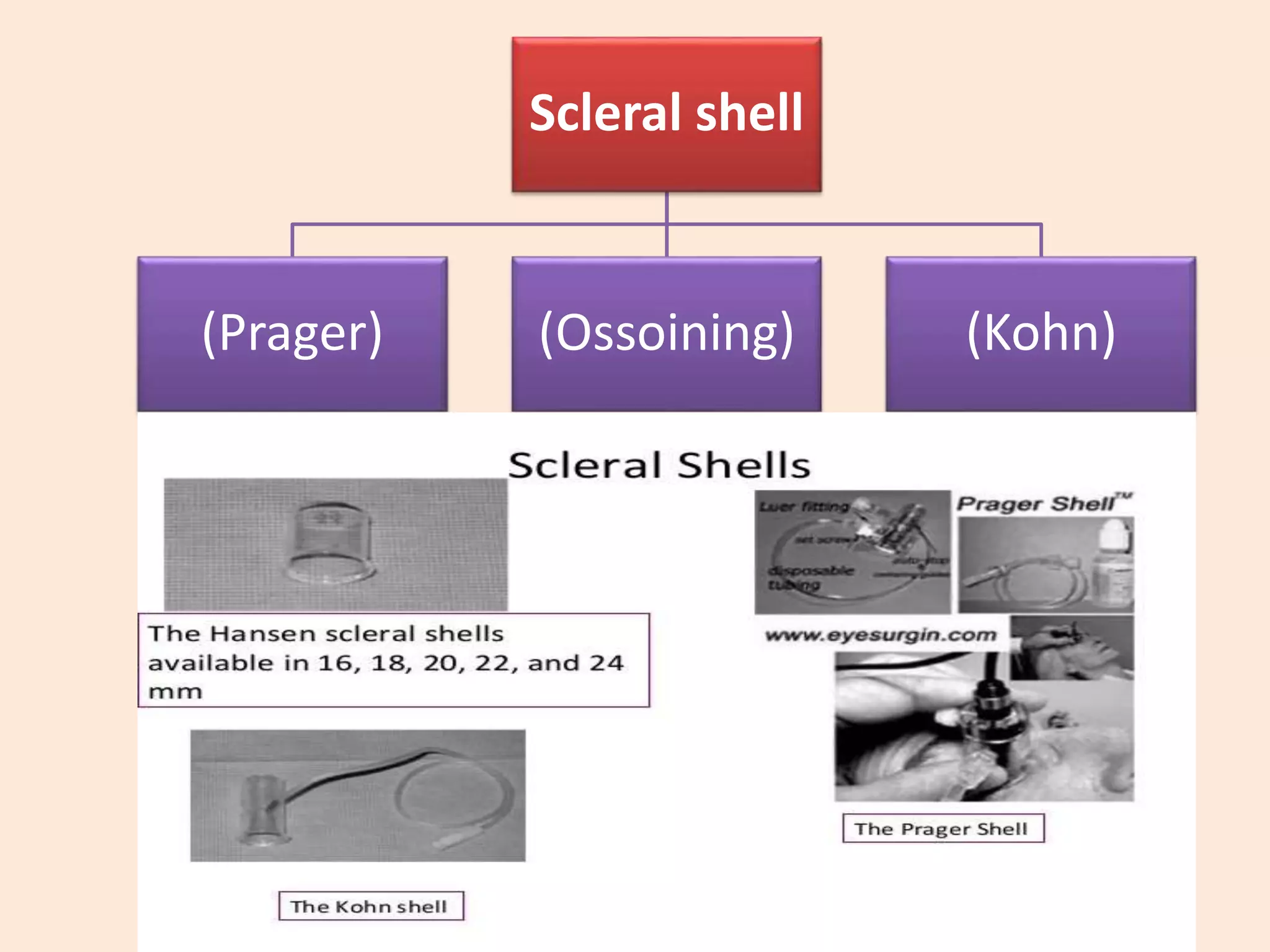 Scleral shell
(Prager) (Ossoining) (Kohn)
 