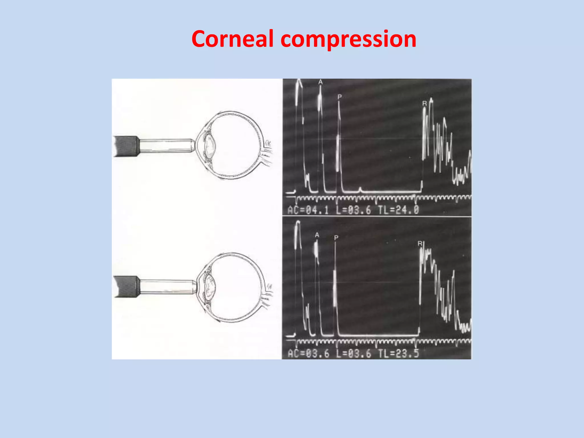 Corneal compression
 