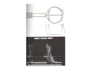 National Ocular Biometry Course (NOBC) 2015 An echoslide presentation ...