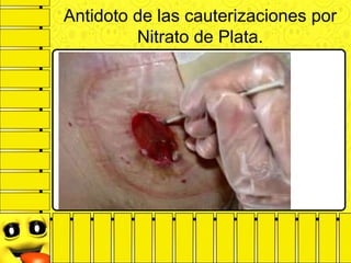 Antidoto de las cauterizaciones por
Nitrato de Plata.
 