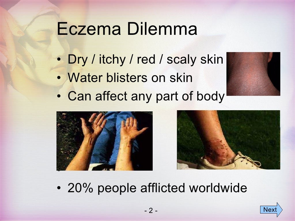 Natural Eczema Cures Cure For Eczema Rash With Natural Products