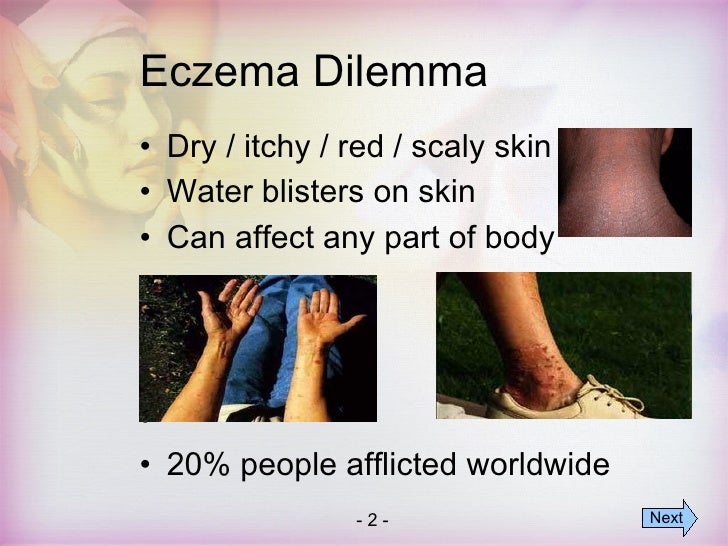 Natural Eczema Cures Cure For Eczema Rash With Natural Products