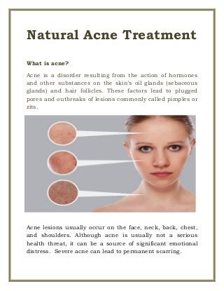 Natural Acne Treatment
What is acne?
Acne is a disorder resulting from the action of hormones
and other substances on the skin’s oil glands (sebaceous
glands) and hair follicles. These factors lead to plugged
pores and outbreaks of lesions commonly called pimples or
zits.
Acne lesions usually occur on the face, neck, back, chest,
and shoulders. Although acne is usually not a serious
health threat, it can be a source of significant emotional
distress. Severe acne can lead to permanent scarring.
 