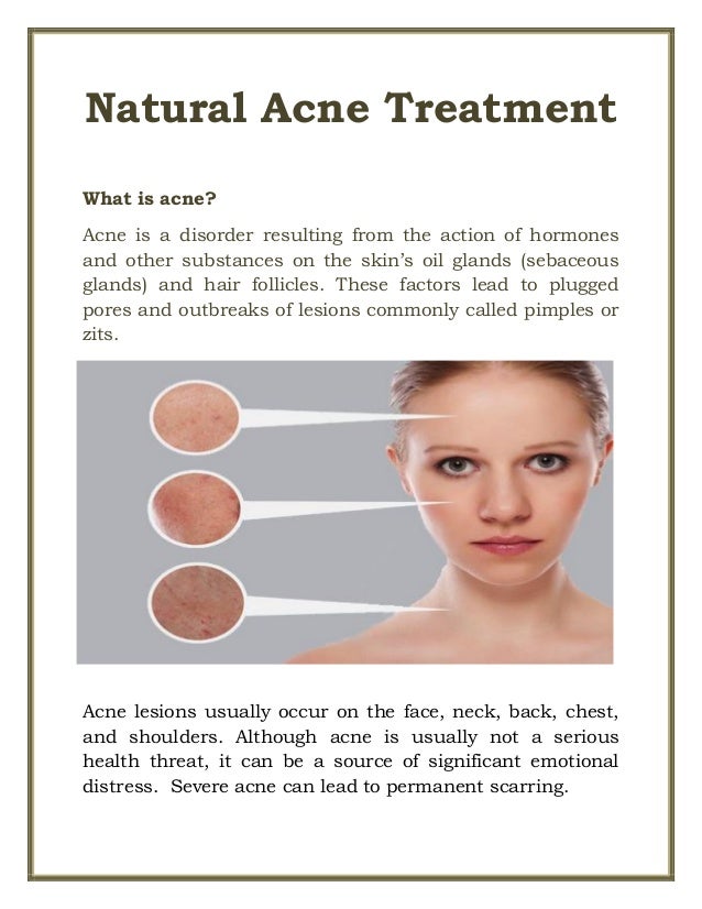 Natural Acne Treatment