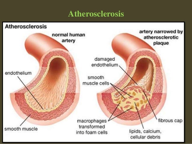 Natural Treatment For Familial Hypercholesterolemia Natural Treatment For Familial Hypercholesterolemia