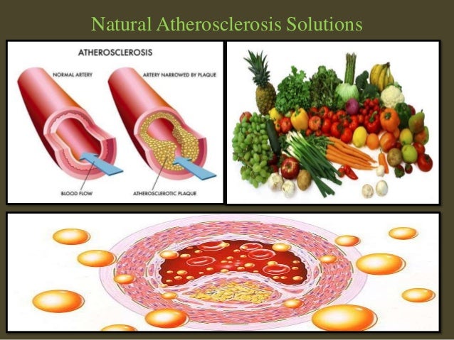 Natural Atherosclerosis Treatment