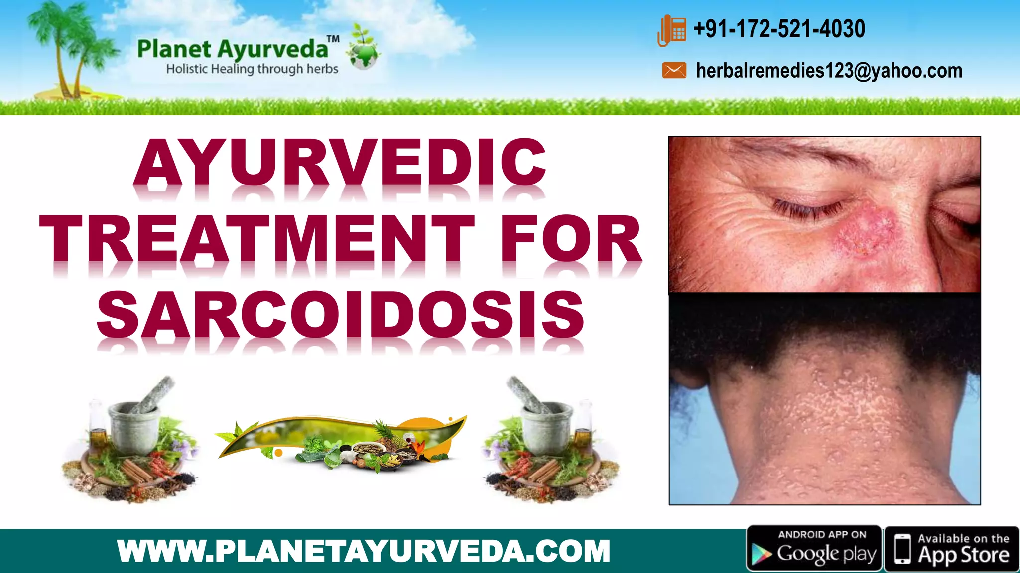 Natural Ayurvedic Herbal Remedies for Sarcoidosis PPT
