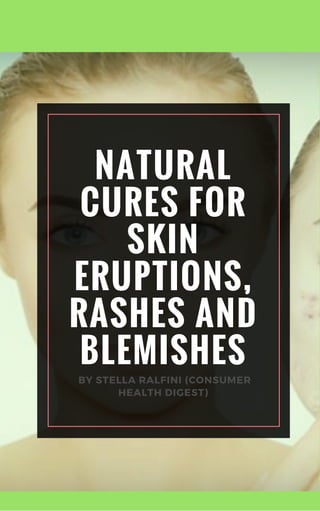 NATURAL
CURES FOR
SKIN
ERUPTIONS,
RASHES AND
BLEMISHES
 BY STELLA RALFINI (CONSUMER
HEALTH DIGEST)
 