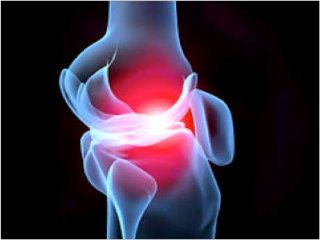 Natural remedies for inflammatory arthritis