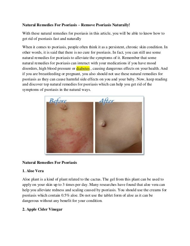 Natural Remedies For Psoriasis Remove Psoriasis Naturally!