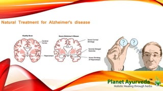Natural Treatment for Alzheimer's disease 
 