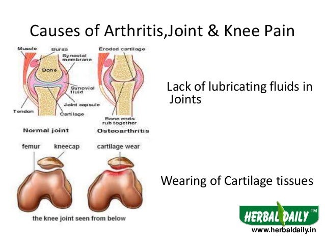 natural-treatment-for-arthiritisjoint-knee-pain-7-638.jpg