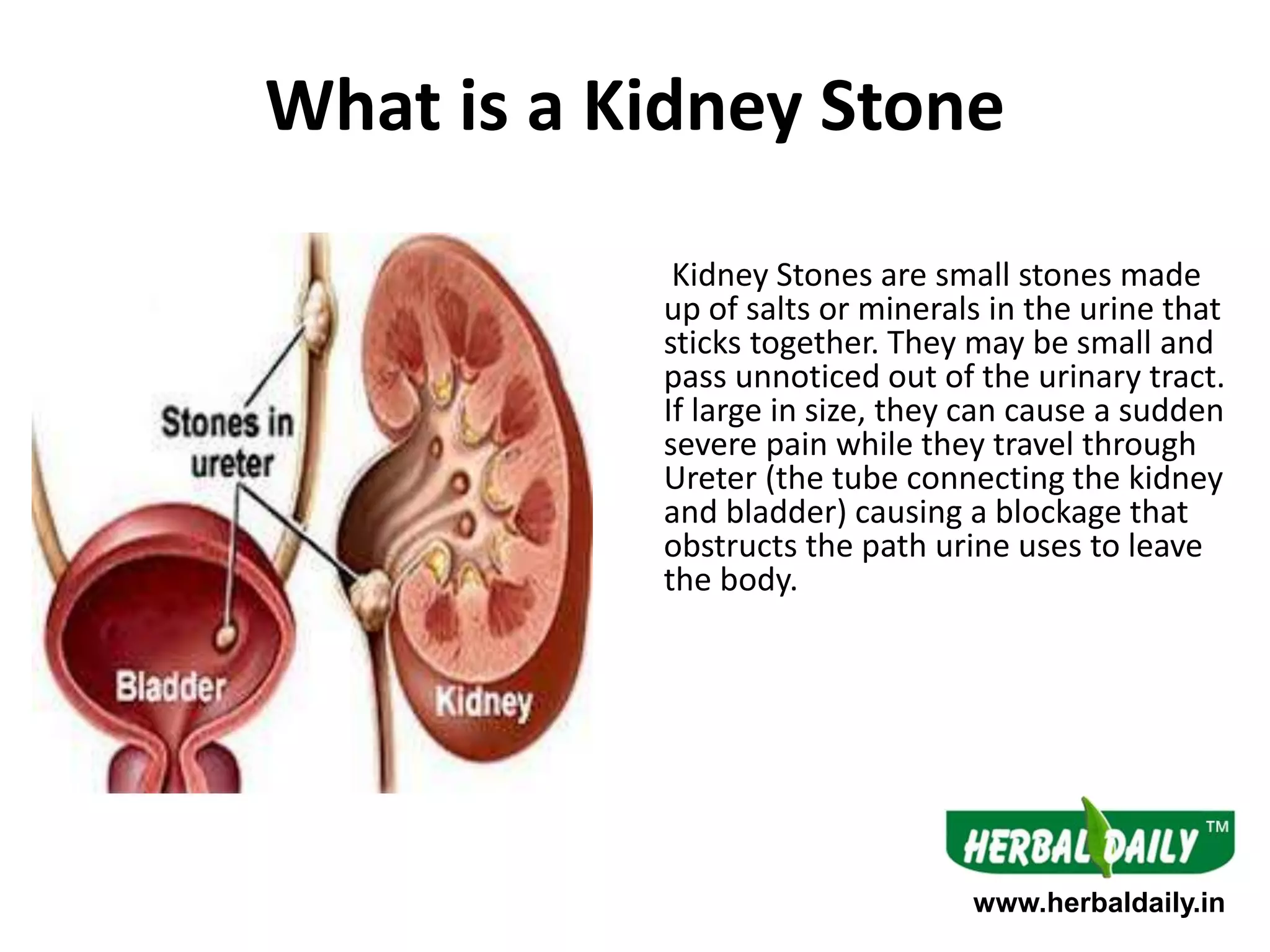 Salt Bladder Natural treatment for kidney stones | PPTX