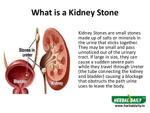 Where can you find a picture of a kidney stone?