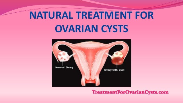 Holistic Treatments For Ovarian Cysts Without Surgery