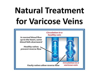 Natural Treatment
for Varicose Veins
 