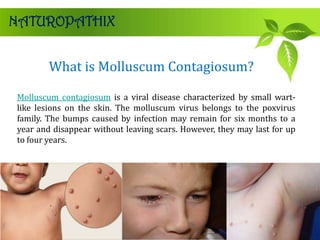What is Molluscum Contagiosum?
NATUROPATHIX
Molluscum contagiosum is a viral disease characterized by small wart-
like lesions on the skin. The molluscum virus belongs to the poxvirus
family. The bumps caused by infection may remain for six months to a
year and disappear without leaving scars. However, they may last for up
to four years.
 
