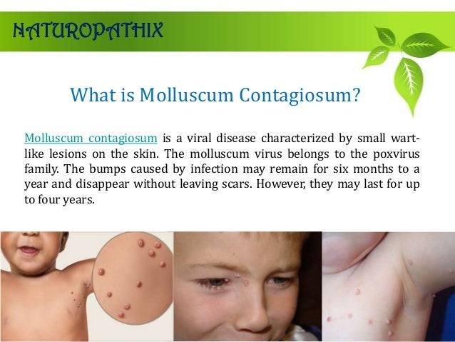 What is Molluscum Contagiosum?NATUROPATHIXMolluscum contagiosum is a 