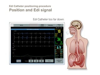 Edi Catheter positioning procedure
Position and Edi signal
 