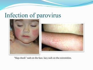 Parvo virus | PPTX