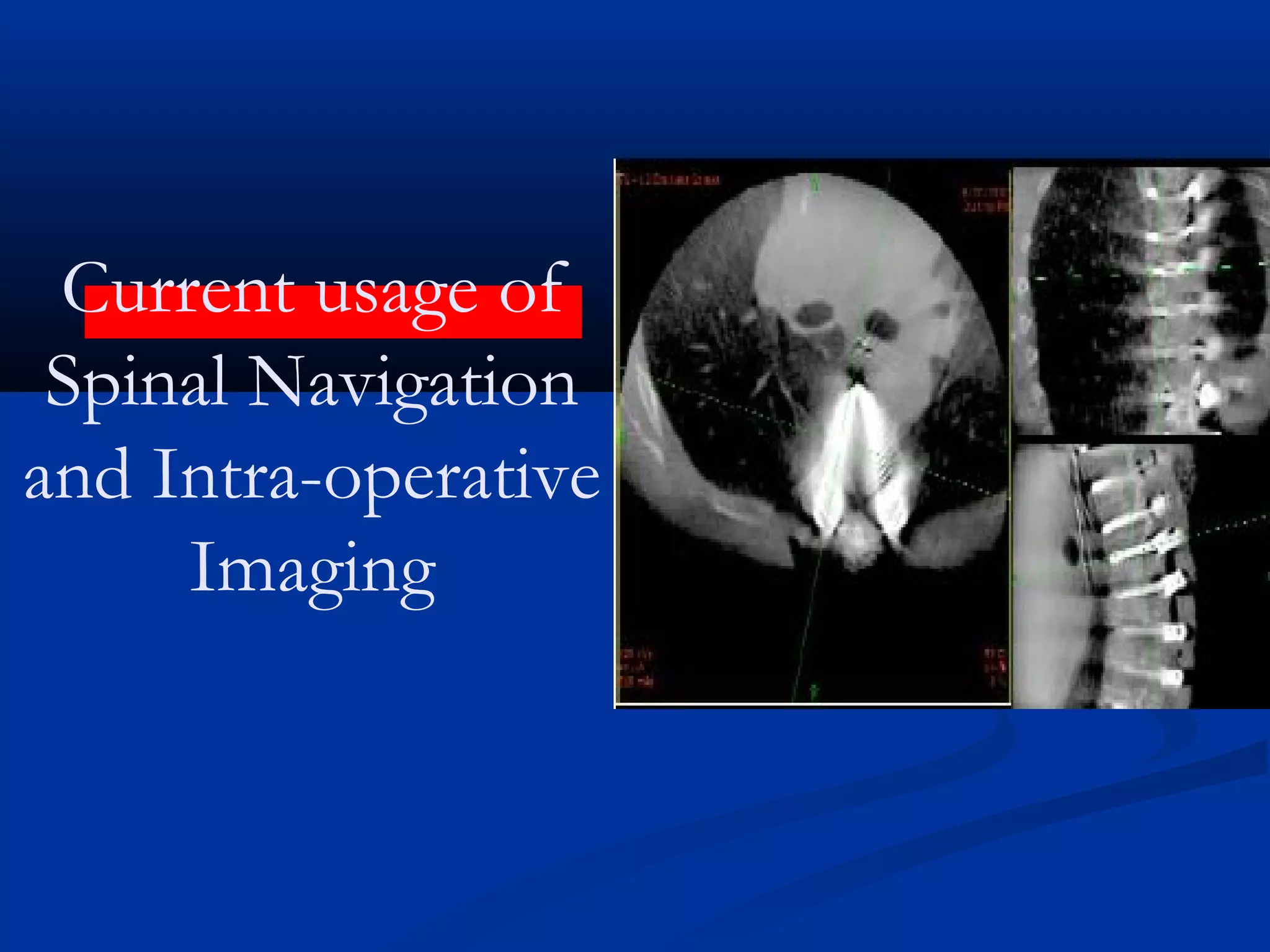 Current usage of
Spinal Navigation
and Intra-operative
Imaging
 
