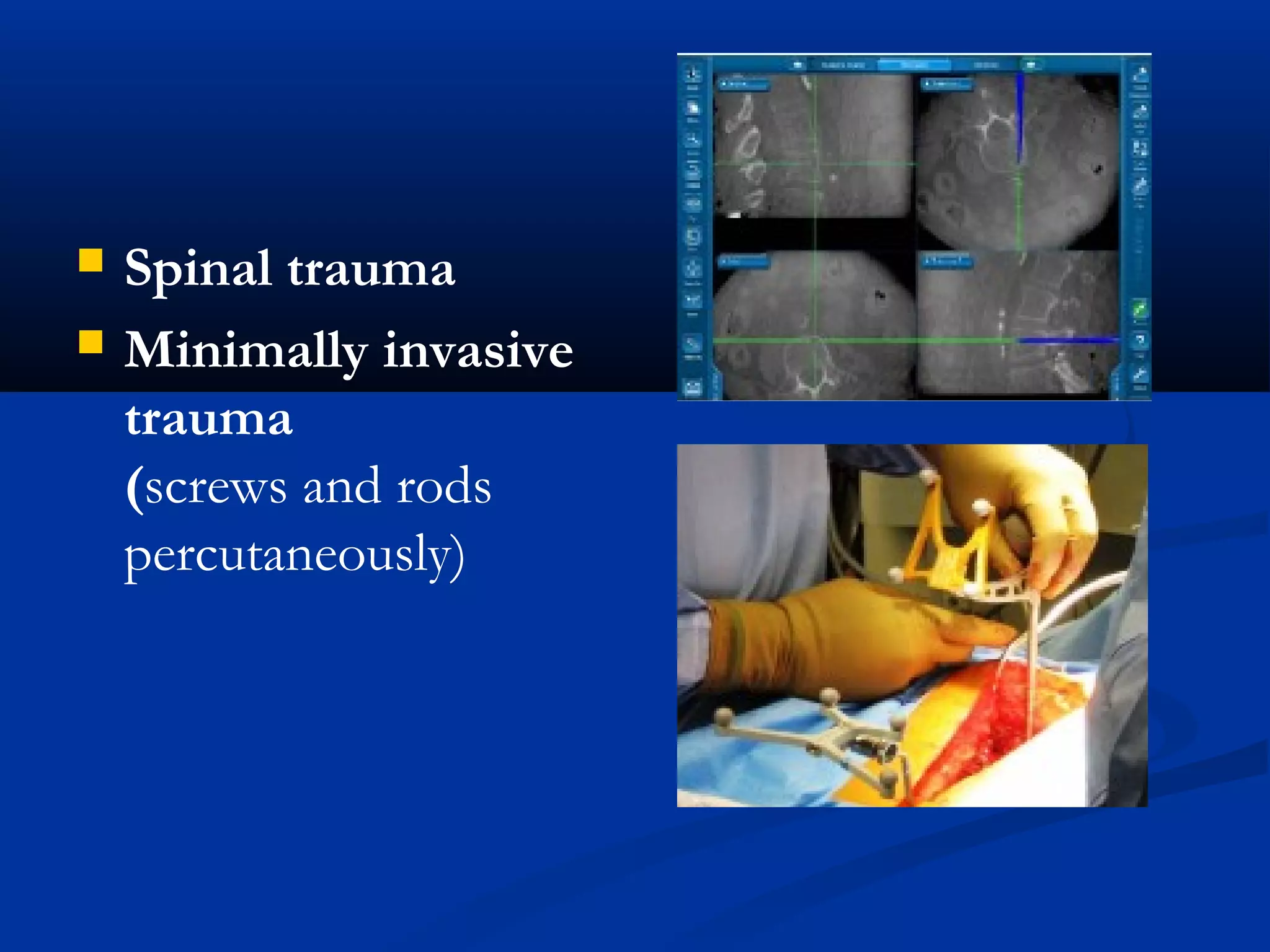  Spinal trauma
 Minimally invasive
trauma
(screws and rods
percutaneously)
 