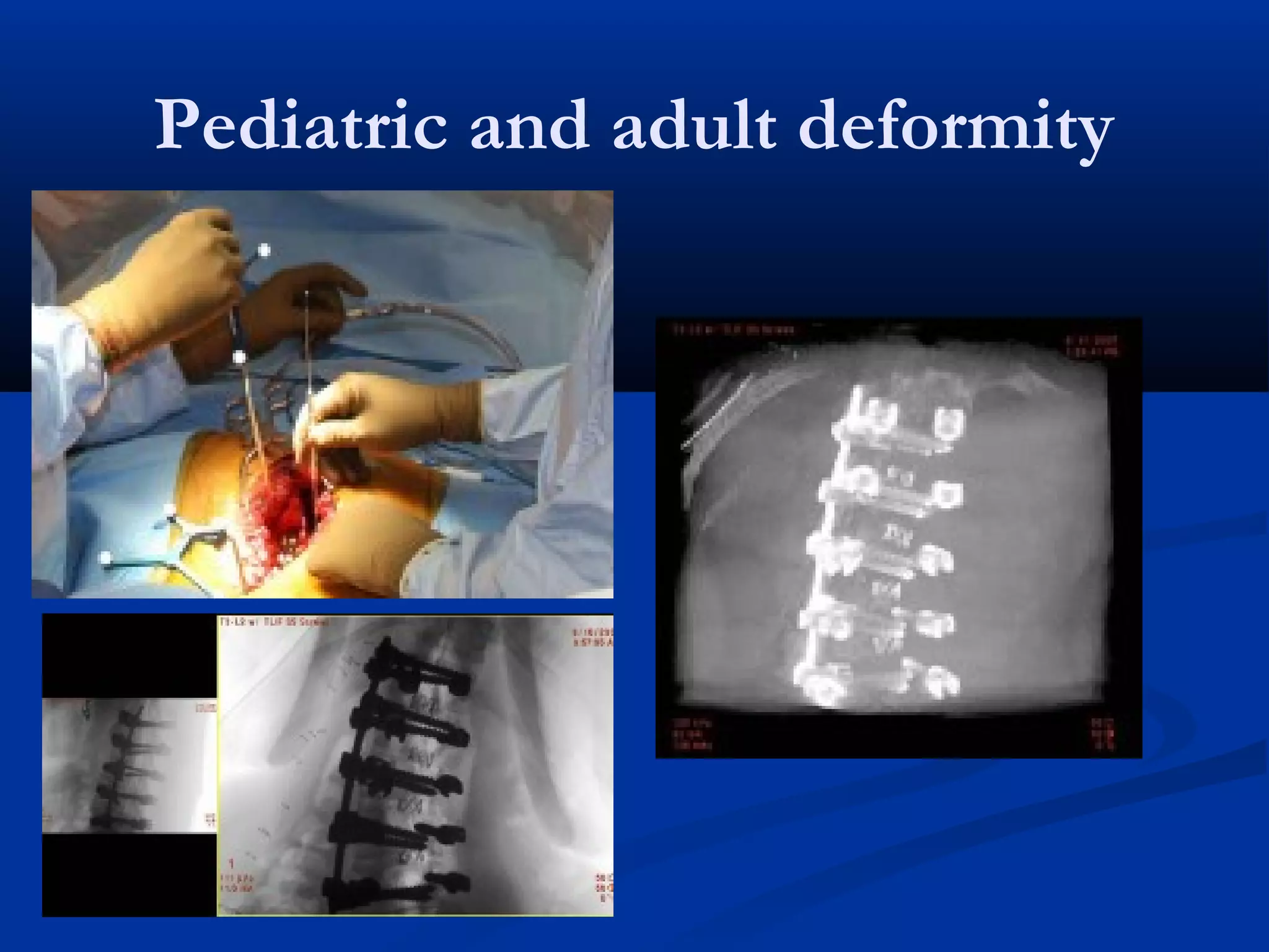 Pediatric and adult deformity
 