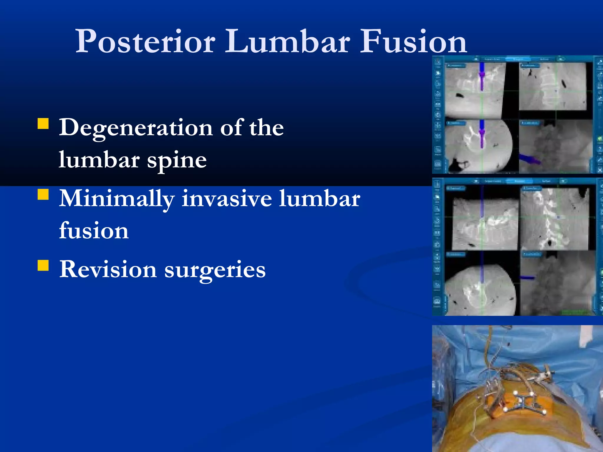 Posterior Lumbar Fusion
 Degeneration of the
lumbar spine
 Minimally invasive lumbar
fusion
 Revision surgeries
 