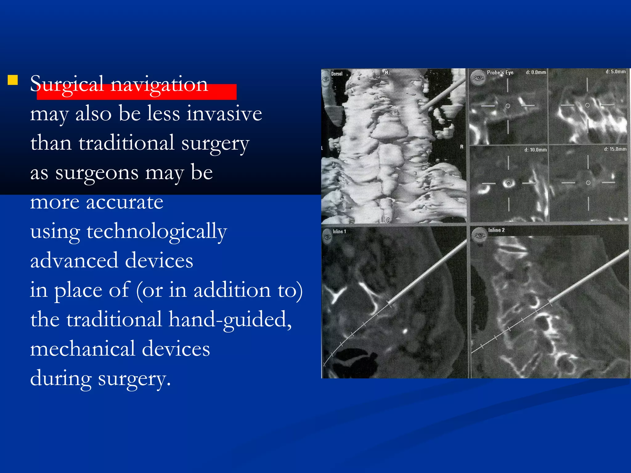  Surgical navigation
may also be less invasive
than traditional surgery
as surgeons may be
more accurate
using technologically
advanced devices
in place of (or in addition to)
the traditional hand-guided,
mechanical devices
during surgery.
 
