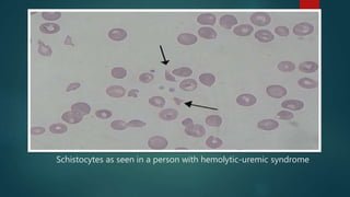 Schistocytes as seen in a person with hemolytic-uremic syndrome
 