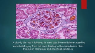 A bloody diarrhea is followed in a few days by renal failure caused by
endothelial injury from the toxin, leading to the characteristic fibrin
thrombi in glomerular and interstitial capillaries.
 